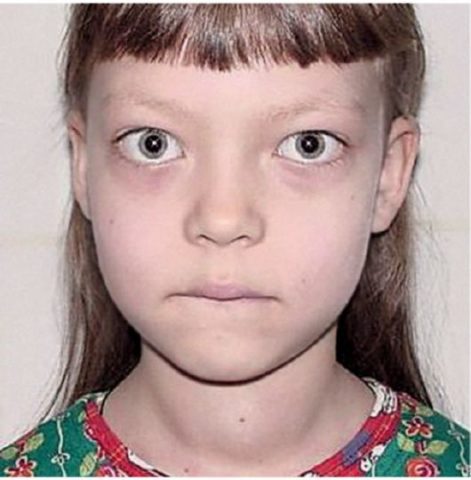 Фото пациентки с гипотиреозом