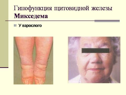 Микседема весьма характерно проявляется отеками лица и других частей тела