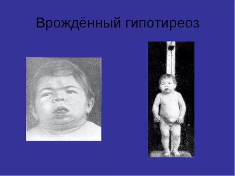 Болезнь кретинизм на фоне врожденного гипотиреоза.