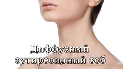 Диффузный эутиреоидный зоб, нулевая степень