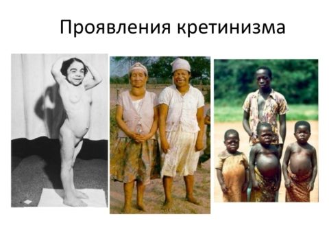 Фотографии больных кретинизмом в различном возрасте Фотографии больных кретинизмом в различном возрасте
