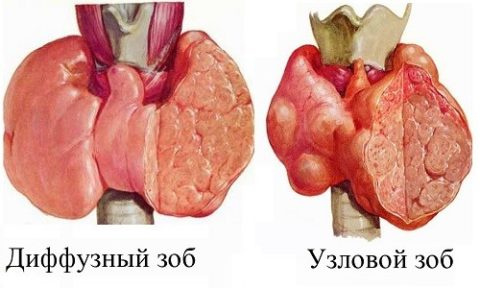 Отличия диффузного и узлового зоба щитовидной железы