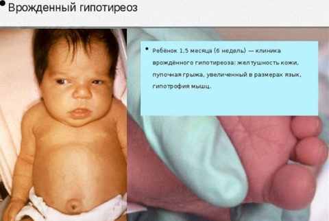 Пример влияния нарушения уровня гормонов щитовидной железы на развитие ребенка
