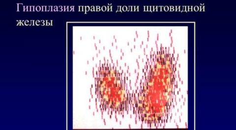 Выраженная гипоплазия правой доли щитовидной железы Выраженная гипоплазия правой доли щитовидной железы