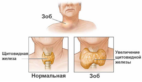 Как проявляется дисфункция щитовидной железы. Как проявляется дисфункция щитовидной железы.