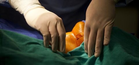 Хирургическое лечение щитовидной железы