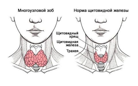 Отличие многоузлового зоба от нормального состояния железы
