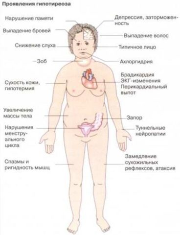 Проверьте себя: на картинке собраны частые симптомы гипотиреоза Проверьте себя: на картинке собраны частые симптомы гипотиреоза