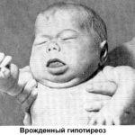 Рот полуоткрыт, язык увеличен в размерах