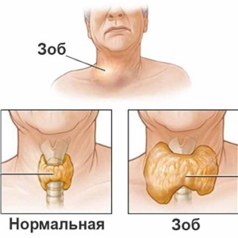 Увеличение ЩЖ в размерах и развитие зоба – показание для операции