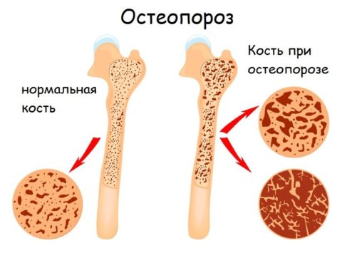 Изменения в костях происходят от выведения кальция из организма при гиперпаратиреозе.