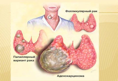Тиреоглобулин может быть повышен при раке щитовидной железы