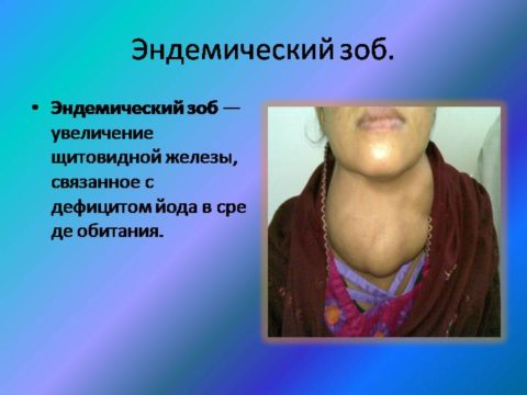 Характерный эндемический зоб у пациентки.