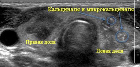 Различные виды кальцинатов щитовидки