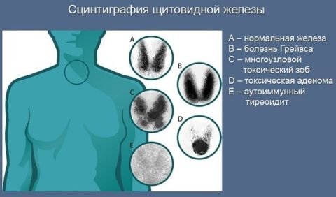При помощи сцинтиграфии можно с достаточной точностью установить или подтвердить диагноз При помощи сцинтиграфии можно с достаточной точностью установить или подтвердить диагноз