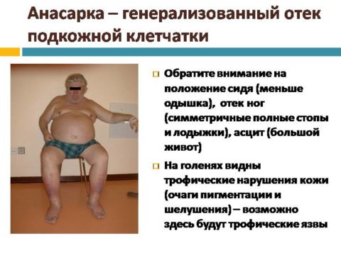 Анасарка является признаком запущенной сердечной недостаточности