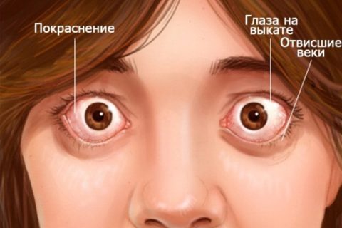Экзофтальм является одним из самых ярких симптомов базедовой болезни