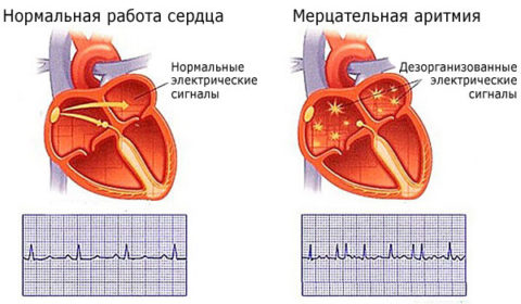 Аритмия