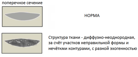 Пример описания эхоструктуры поджелудочной железы Пример описания эхоструктуры поджелудочной железы