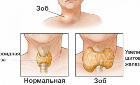 Гипертрофическая