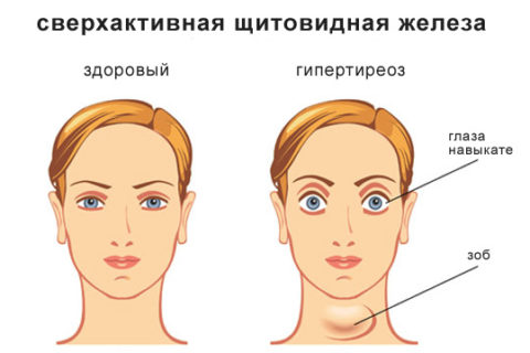 Гипертрофическая форма