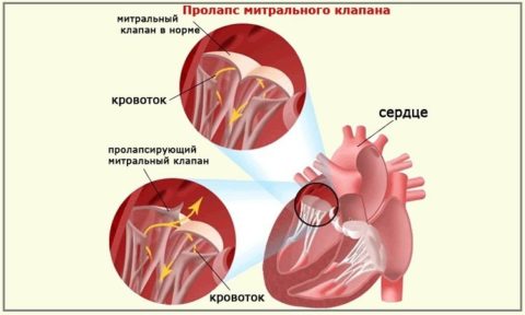 Миксоматозный пролапс митрального клапана развивается под влиянием тиреотоксикоза Миксоматозный пролапс митрального клапана развивается под влиянием тиреотоксикоза