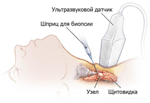 Тонкоигольная аспирационная пункционная биопсия (ТАПБ) Тонкоигольная аспирационная пункционная биопсия (ТАПБ)