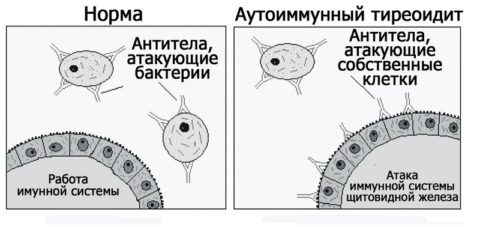 АИТ – основная причина гипотиреоза АИТ – основная причина гипотиреоза