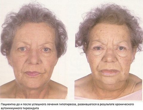 Признаки АИТ на лице (слева) Признаки АИТ на лице (слева)