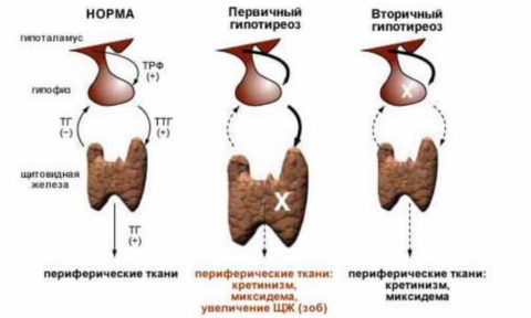 Гормональные особенности гипотиреоза