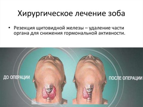 Радикальная терапия зоба