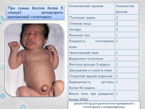 Диагностика гипотиреоза у новорожденных по шкале Апгар Диагностика гипотиреоза у новорожденных по шкале Апгар